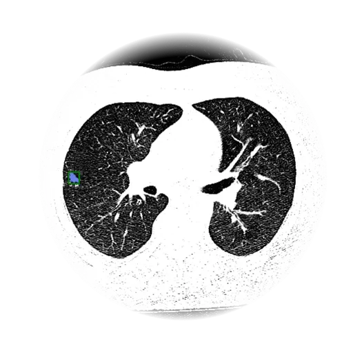Tumor Detection